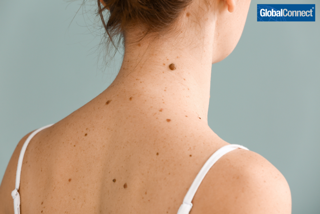 What to know about skin spots